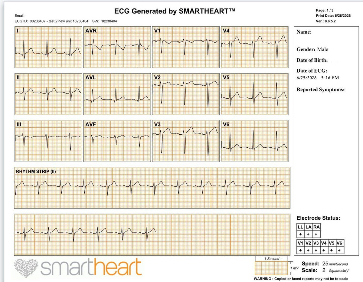 A SmartHeart 12-lead EKG report showing all twelve leads, a rhythm strip, and electrode status